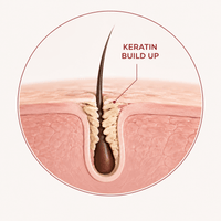 Keratin Build-Up